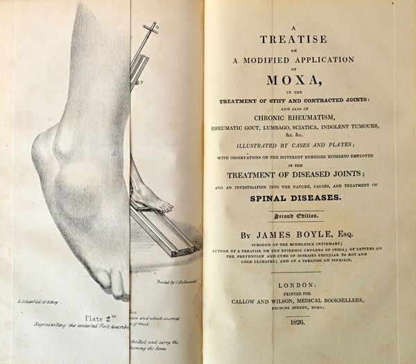 LARREY (Baron D.J.)  On the Use of the Moxa, as a therapeutical agent. Translated  . . .  with notes, and  . . .  containing a history of the substanc