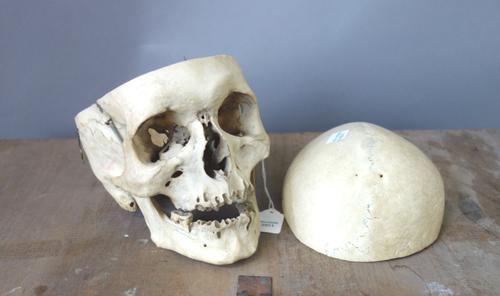Anatomical teaching aids, 19th century, including; two human skulls, each with detachable cranium and spring loaded jaw, and a quantity of human bones